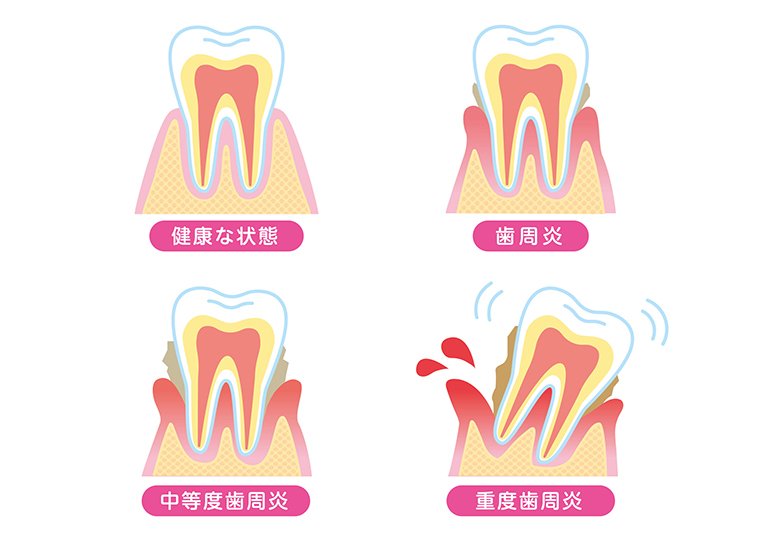 歯周病の進行